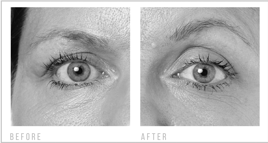 Before-and-After-Eye-Revive-(1)-bw