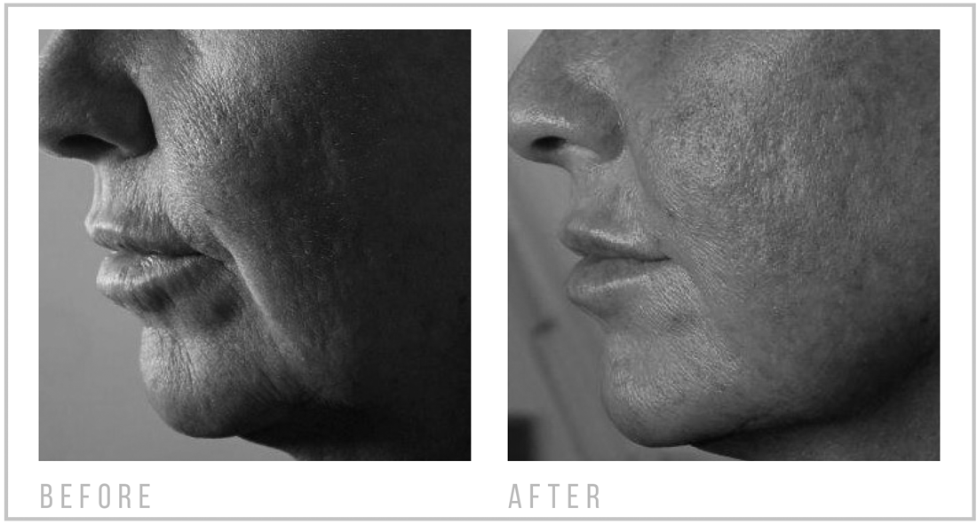 Image-Credit-MJ-Beauty-Treatment-Synergy-Purifying-and-Jowl-Lift-bw